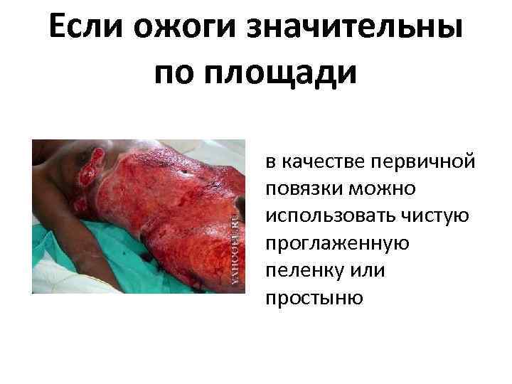 Если ожоги значительны по площади в качестве первичной повязки можно использовать чистую проглаженную пеленку