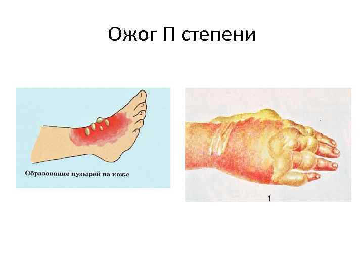 Ожог П степени 