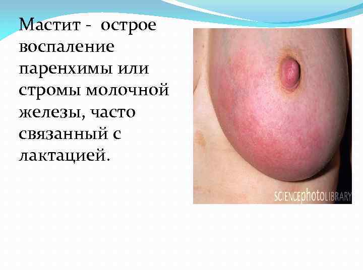 Мастит - острое воспаление паренхимы или стромы молочной железы, часто связанный с лактацией. 