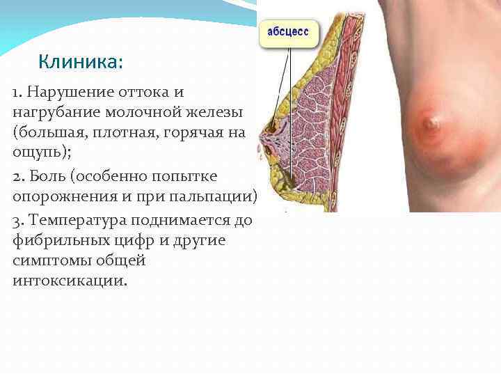 Клиника: 1. Нарушение оттока и нагрубание молочной железы (большая, плотная, горячая на ощупь); 2.