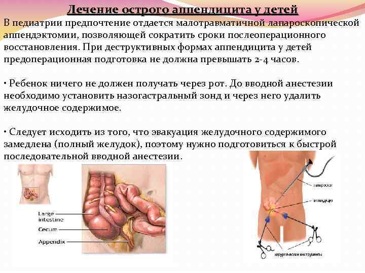 Аппендицит с какой стороны у женщины. Симптомы при остром аппендиците у детей. При остром аппендиците наблюдаются симптомы:. Болевые симптомы при аппендиците. Воспаление аппендикса симптомы.