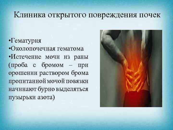 Клиника открытого повреждения почек • Гематурия • Околопочечная гематома • Истечение мочи из раны