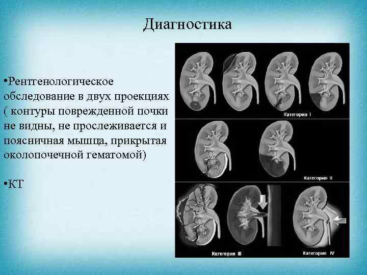 Диагностика • Рентгенологическое обследование в двух проекциях ( контуры поврежденной почки не видны, не