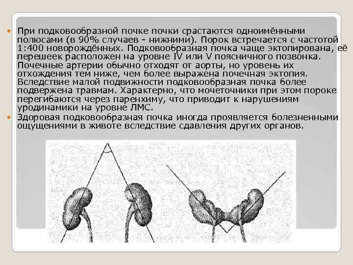 При подковообразной почке почки срастаются одноимёнными полюсами (в 90% случаев - нижними). Порок встречается