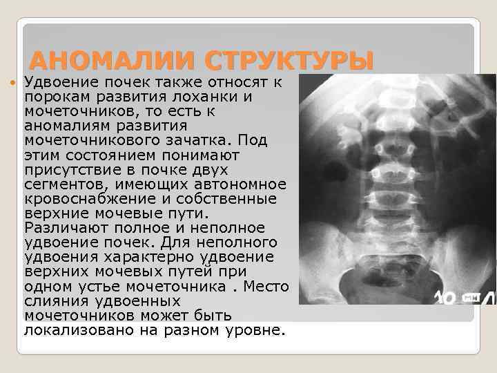 АНОМАЛИИ СТРУКТУРЫ Удвоение почек также относят к порокам развития лоханки и мочеточников, то есть