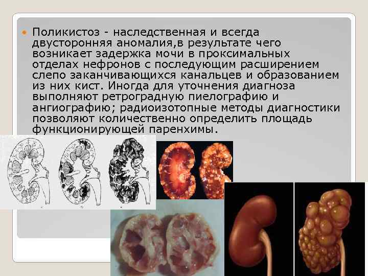  Поликистоз - наследственная и всегда двусторонняя аномалия, в результате чего возникает задержка мочи
