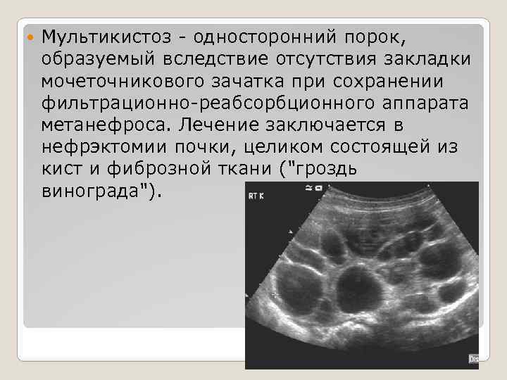  Мультикистоз - односторонний порок, образуемый вследствие отсутствия закладки мочеточникового зачатка при сохранении фильтрационно-реабсорбционного