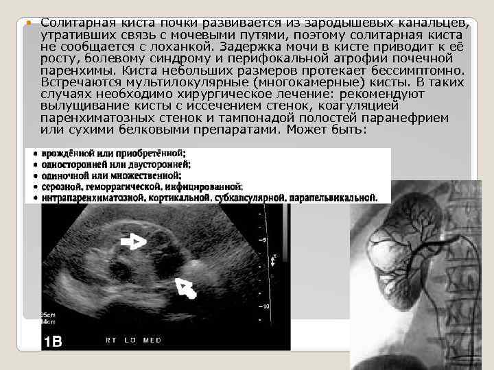  Солитарная киста почки развивается из зародышевых канальцев, утративших связь с мочевыми путями, поэтому
