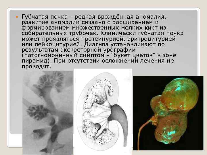  Губчатая почка - редкая врождённая аномалия, развитие аномалии связано с расширением и формированием