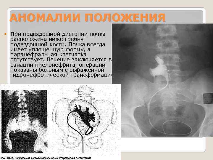 Аномалии мочеточников презентация