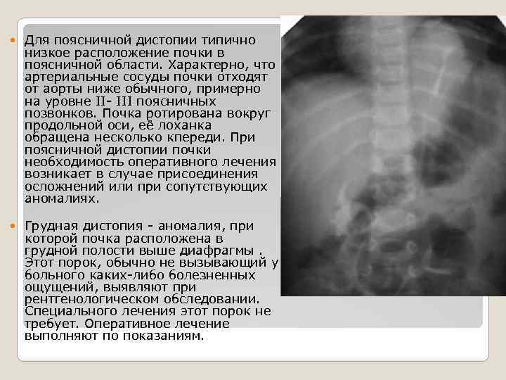  Для поясничной дистопии типично низкое расположение почки в поясничной области. Характерно, что артериальные