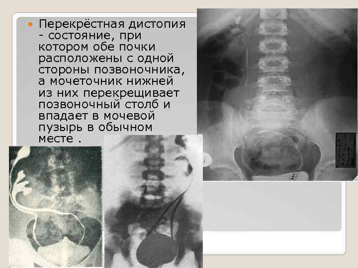Нефроптоз дистопия. Дистопия почки рентген. Перекрестная дистопия почки. Подвздошная дистопия почки.
