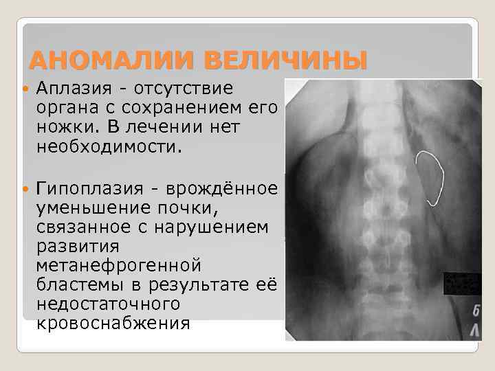 АНОМАЛИИ ВЕЛИЧИНЫ Аплазия - отсутствие органа с сохранением его ножки. В лечении нет необходимости.