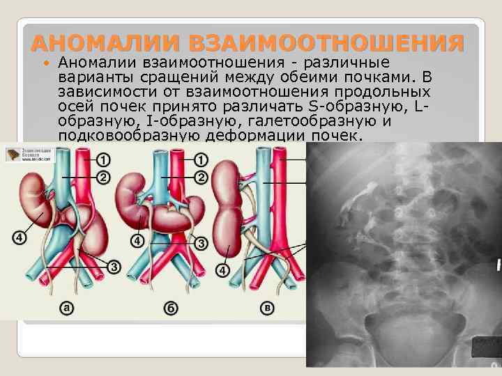 АНОМАЛИИ ВЗАИМООТНОШЕНИЯ Аномалии взаимоотношения - различные варианты сращений между обеими почками. В зависимости от
