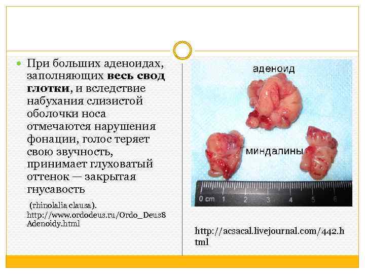  При больших аденоидах, заполняющих весь свод глотки, и вследствие набухания слизистой оболочки носа