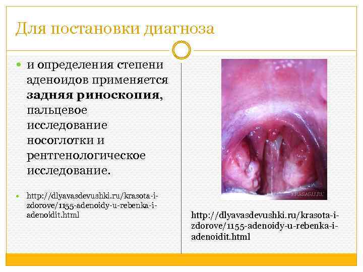 Для постановки диагноза и определения степени аденоидов применяется задняя риноскопия, пальцевое исследование носоглотки и