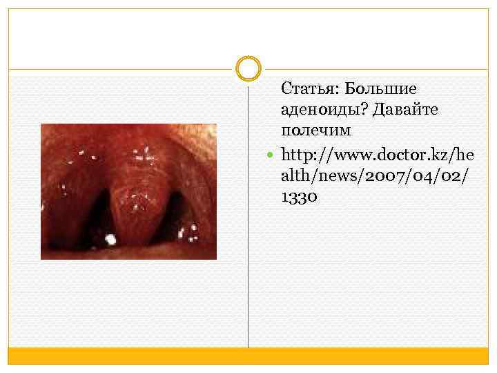 Статья: Большие аденоиды? Давайте полечим http: //www. doctor. kz/he alth/news/2007/04/02/ 1330 