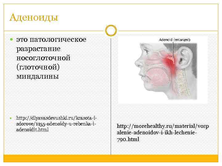 Аденоиды это патологическое разрастание носоглоточной (глоточной) миндалины http: //dlyavasdevushki. ru/krasota-i- zdorove/1155 -adenoidy-u-rebenka-iadenoidit. html http: