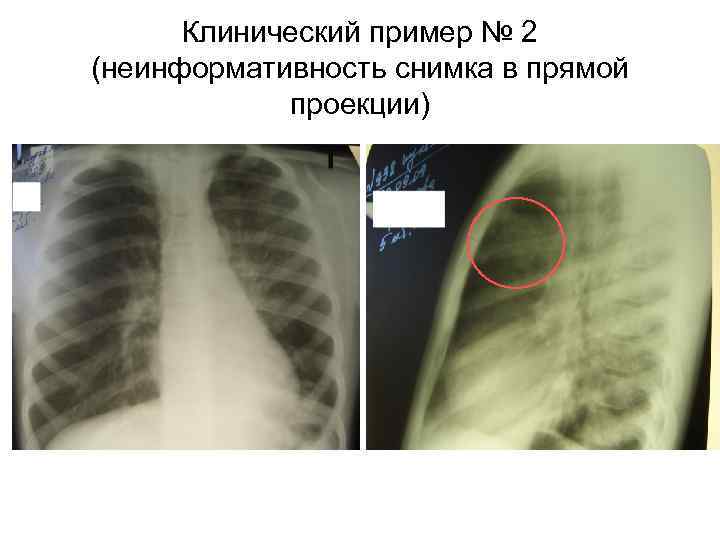 Клинический пример № 2 (неинформативность снимка в прямой проекции) 