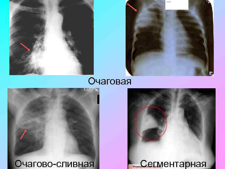 Очаговая Очагово сливная Сегментарная 