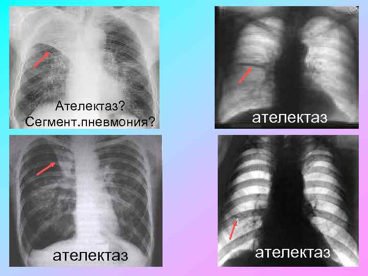 Ателектаз? Сегмент. пневмония? ателектаз 