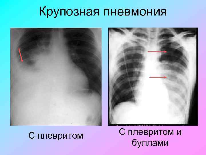 Крупозная пневмония С плевритом и буллами 