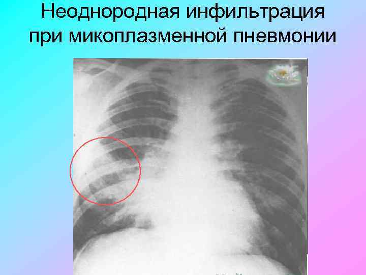 Неоднородная инфильтрация при микоплазменной пневмонии 