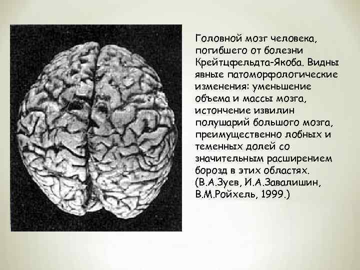Головной мозг человека, погибшего от болезни Крейтцфельдта-Якоба. Видны явные патоморфологические изменения: уменьшение объема и