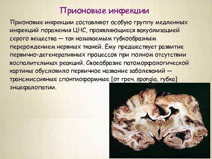 Прионовые инфекции составляют особую группу медленных инфекций поражения ЦНС, проявляющиеся вакуолизацией серого вещества —