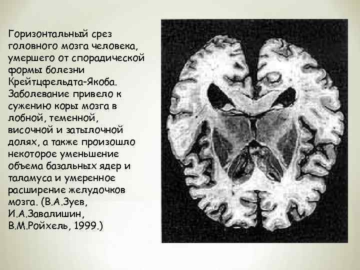 Горизонтальный срез головного мозга человека, умершего от спорадической формы болезни Крейтцфельдта-Якоба. Заболевание привело к