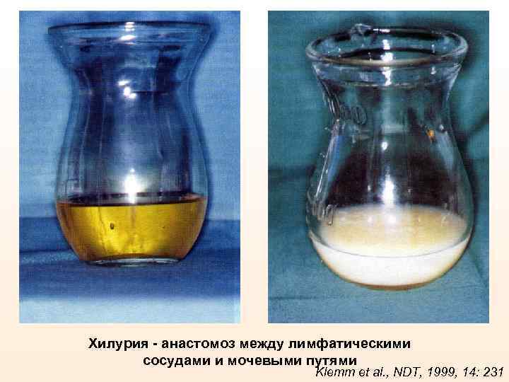 Хилурия - анастомоз между лимфатическими сосудами и мочевыми путями Klemm et al. , NDT,