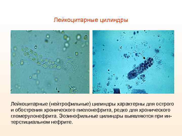 Цилиндрурия характерна. Эритроцитарные цилиндры в моче. Лейкоцитарные цилиндры в моче. Эритроцитарные и лейкоцитарные цилиндры. Эритроцитарные цилиндры характерны для.