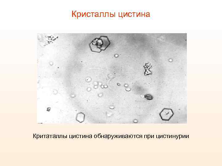 Кристаллы в моче высокие. Кристаллы цистина. Кристаллы цистина в моче. Отложения кристаллов цистина в роговице. Цистин в моче у кошек.