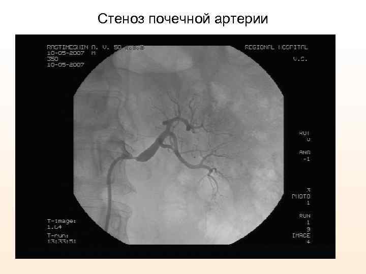 Стеноз почечной артерии 