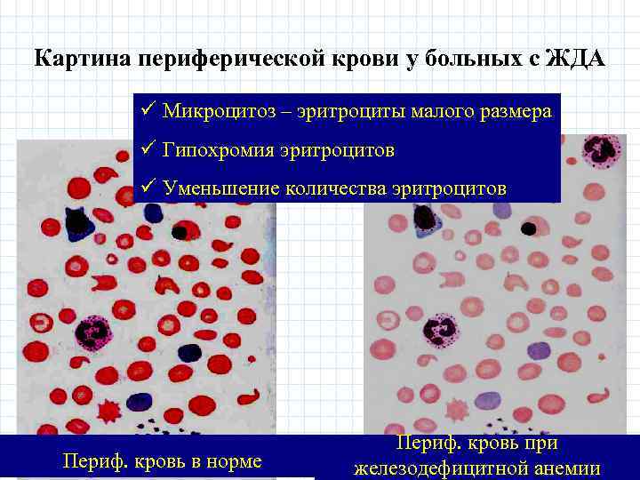 Анемия и эритроциты в крови. Постгеморрагическая анемия показатели крови. Картина крови при железодефицитных анемиях патфиз. Кровь при железодефицитной постгеморрагической анемии. Картина крови при железодефицитной анемии патофизиология.