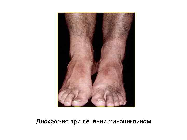 Дисхромия при лечении миноциклином 