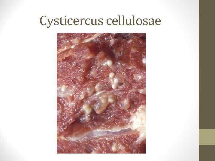 Cysticercus cellulosae 