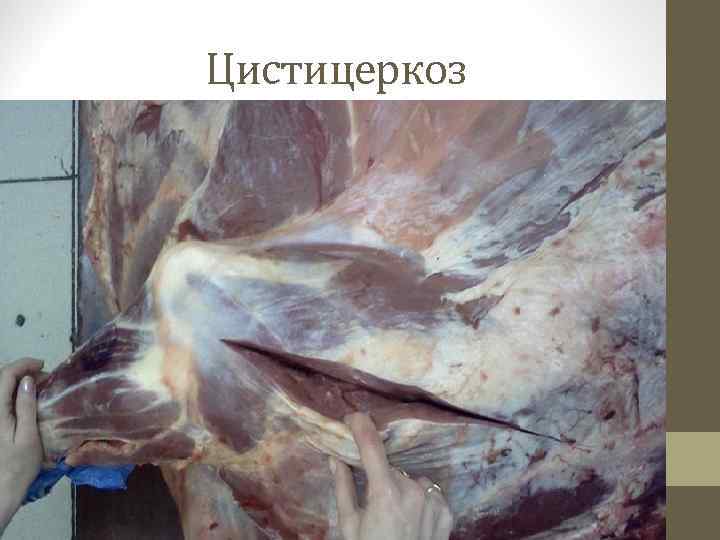 Цистицеркоз 