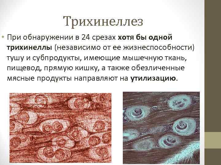 Трихинеллез • При обнаружении в 24 срезах хотя бы одной трихинеллы (независимо от ее