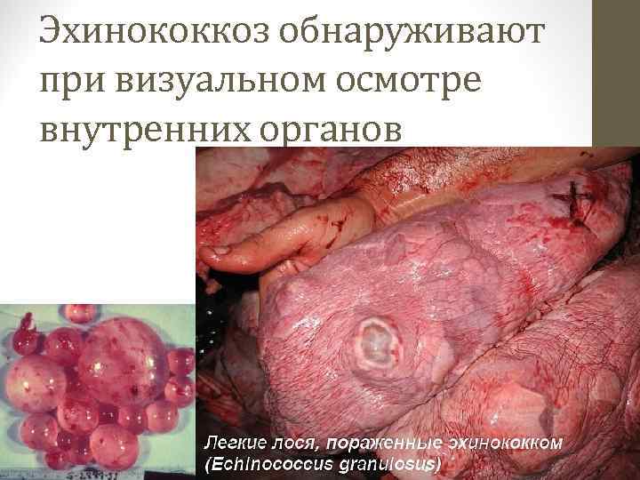 Эхинококкоз обнаруживают при визуальном осмотре внутренних органов 