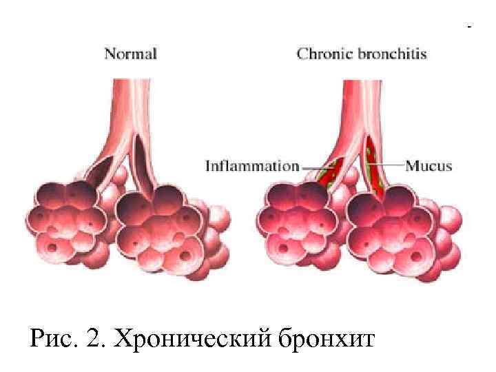Рис. 2. Хронический бронхит 
