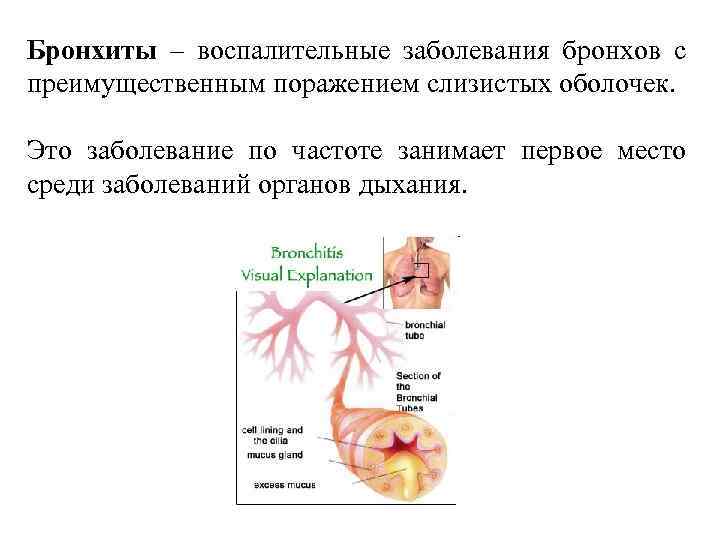 Бронхиты – воспалительные заболевания бронхов с преимущественным поражением слизистых оболочек. Это заболевание по частоте