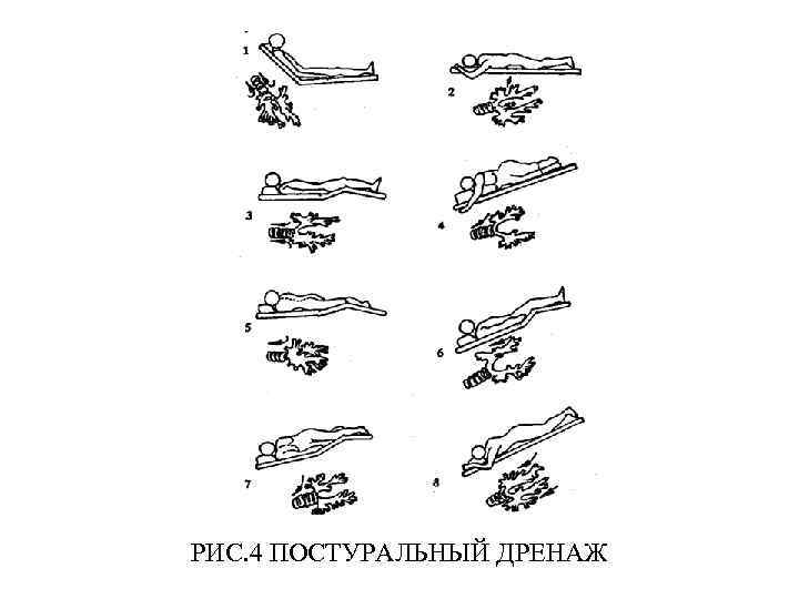 Постуральный дренаж картинка