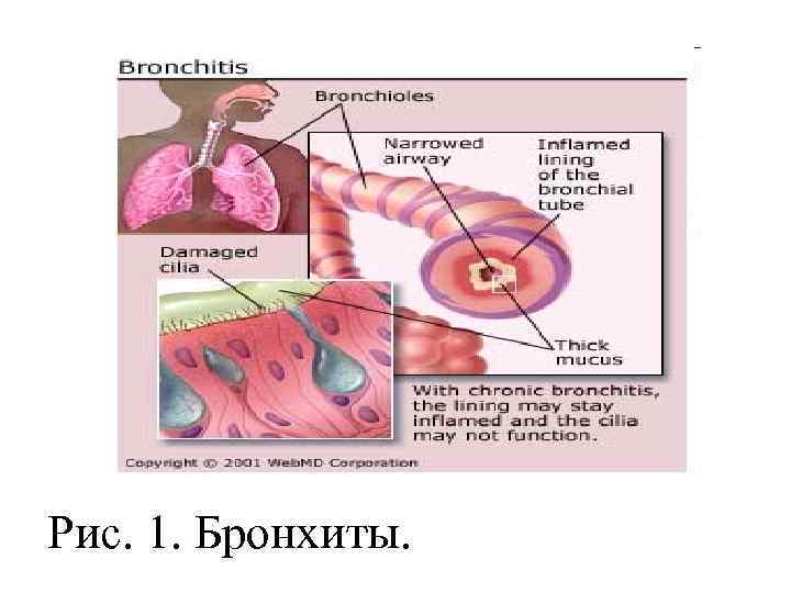 Отделение при бронхите. Бронхит 1-3 порядка.