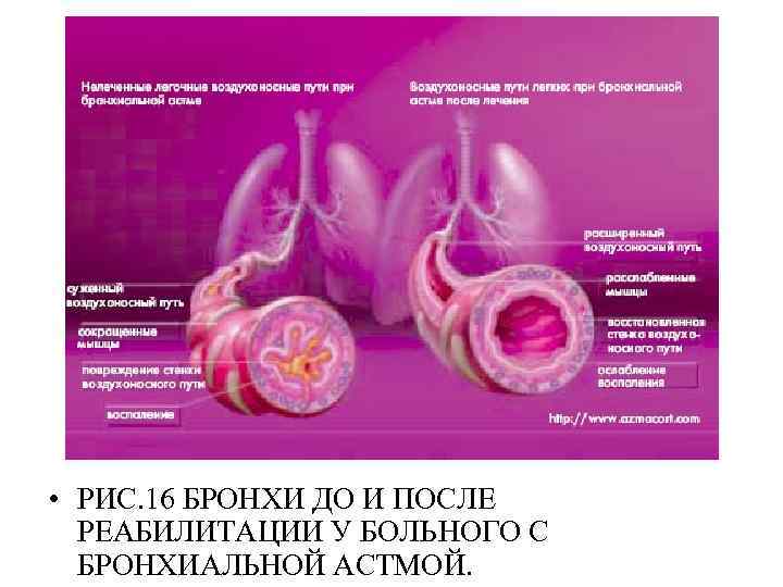  • РИС. 16 БРОНХИ ДО И ПОСЛЕ РЕАБИЛИТАЦИИ У БОЛЬНОГО С БРОНХИАЛЬНОЙ АСТМОЙ.