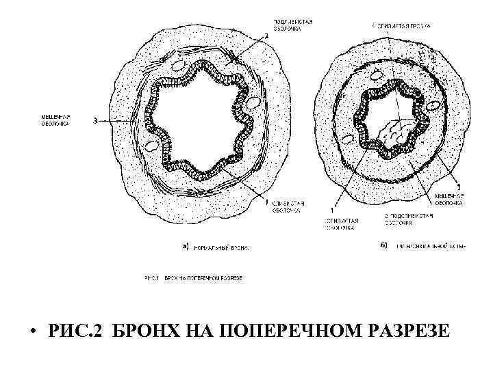  • РИС. 2 БРОНХ НА ПОПЕРЕЧНОМ РАЗРЕЗЕ 