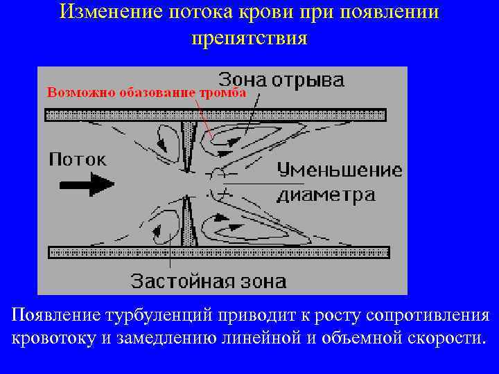 Изменение потока крови при появлении препятствия Появление турбуленций приводит к росту сопротивления кровотоку и