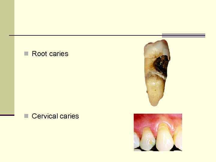 n Root caries n Cervical caries 