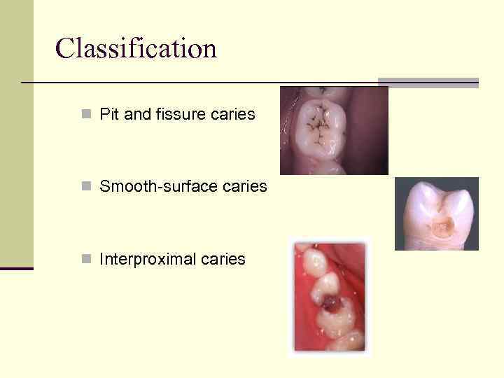 Classification n Pit and fissure caries n Smooth-surface caries n Interproximal caries 