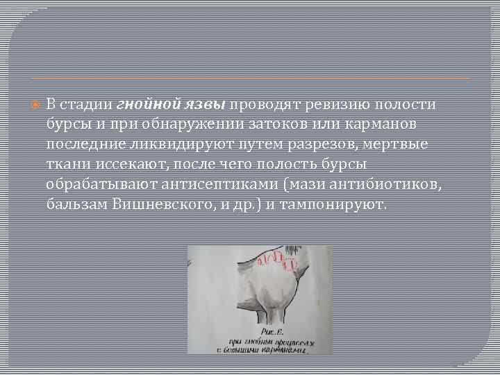 В стадии гнойной язвы проводят ревизию полости бурсы и при обнаружении затоков или